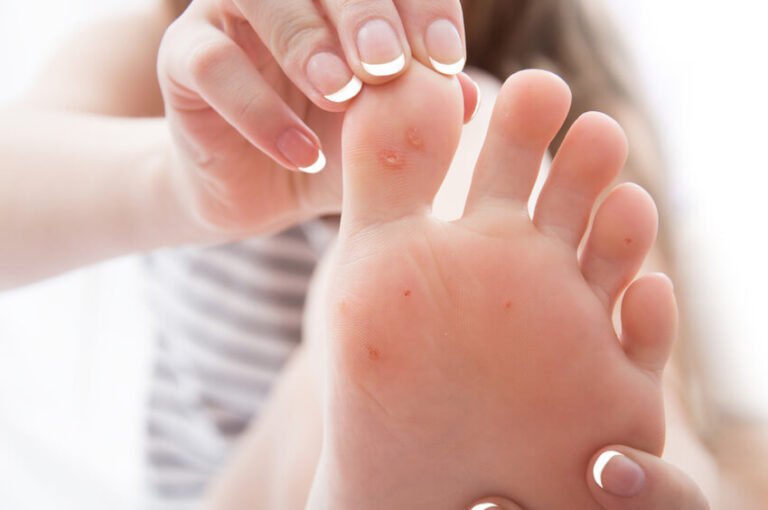 Removing Warts: How To Get Rid Of Warts?